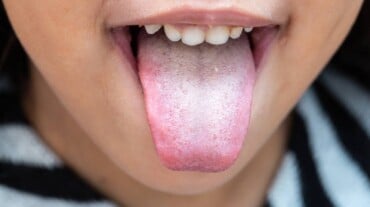 White marks on a tongue
